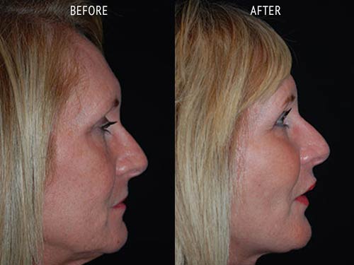 face lift surgery before and after patient results side view photo at Cosmetic Surgery Partners London