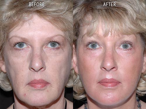 face lift surgery before and after patient results front view photo at Cosmetic Surgery Partners London