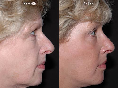 face lift surgery before and after patient results side view photo at Cosmetic Surgery Partners London