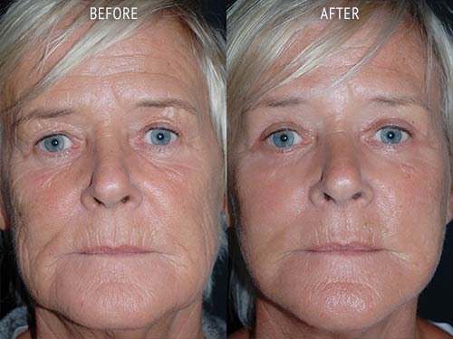 face lift surgery before and after patient results front view photo at Cosmetic Surgery Partners London