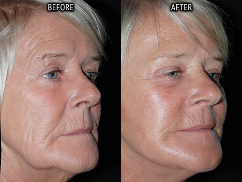 face lift surgery before and after patient results oblique angle view photo at Cosmetic Surgery Partners London
