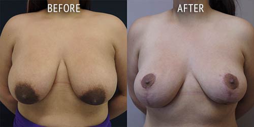 breast uplift surgery before and after patient results front view photo at Cosmetic Surgery Partners London