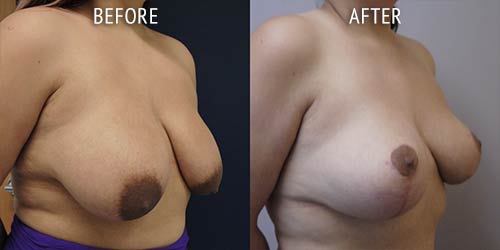 breast uplift surgery before and after patient results oblique angle view photo at Cosmetic Surgery Partners London