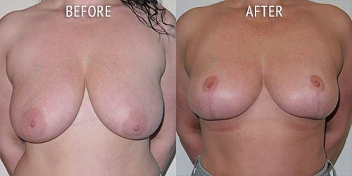 breast uplift surgery before and after patient results front view photo at Cosmetic Surgery Partners London
