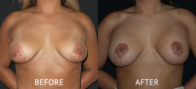 Areolar nipple reduction before after photo by Cosmetic Surgery Partners London Miles Berry