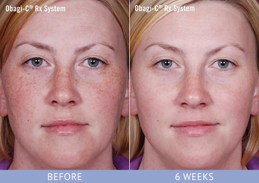 obagi RX system before and after at Cosmetic Surgery Partners London