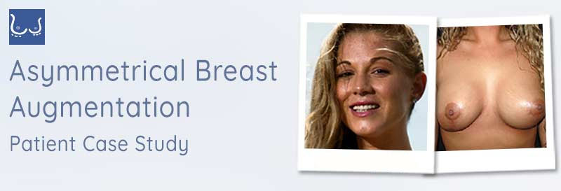 patient-case-study-header-asymmetrical-breast-augmentation