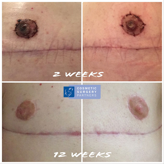 photos nipple scar healing top surgery London F2M FTM