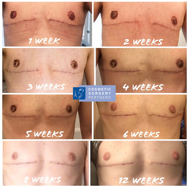 photo of scars healing stages top surgery London F2M FTM at Cosmetic Surgery Partners London