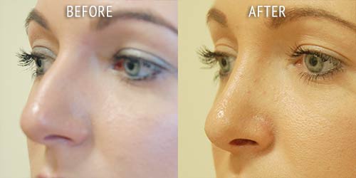 rhinoplasty surgery before and after patient results oblique angle view photo at Cosmetic Surgery Partners London