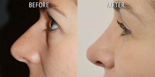 rhinoplasty surgery before and after patient results side view photo at Cosmetic Surgery Partners London