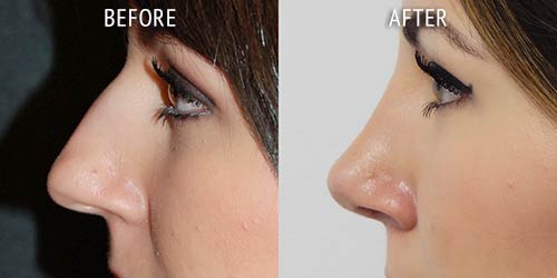 rhinoplasty surgery before and after patient results side view photo at Cosmetic Surgery Partners London