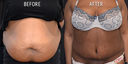 tummy-tuck-patient-before-after-01a