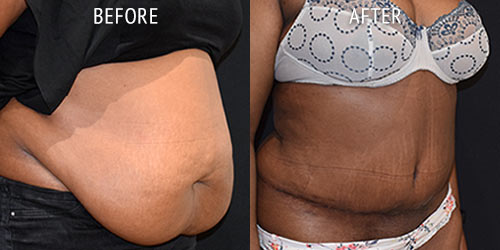 tummy-tuck-patient-before-after-01b