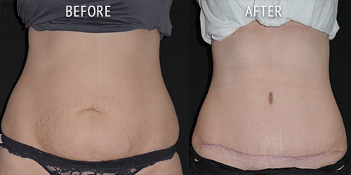 abdominoplasty surgery before and after patient results front view photo at Cosmetic Surgery Partners London