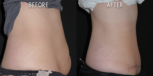 abdominoplasty surgery before and after patient results side view photo at Cosmetic Surgery Partners London