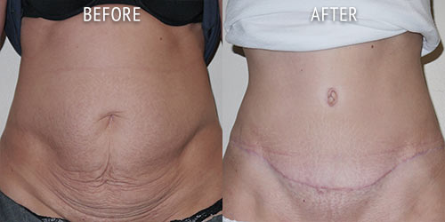 tummy-tuck-patient-before-after-05a