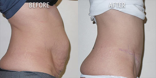 tummy-tuck-patient-before-after-05b