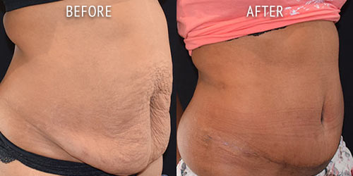 abdominoplasty surgery before and after patient results oblique angle view photo at Cosmetic Surgery Partners London