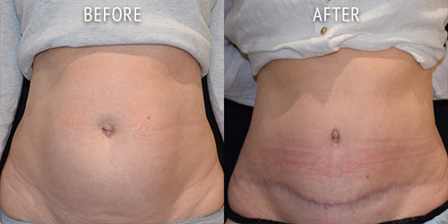 abdominoplasty surgery before and after patient results front view photo at Cosmetic Surgery Partners London